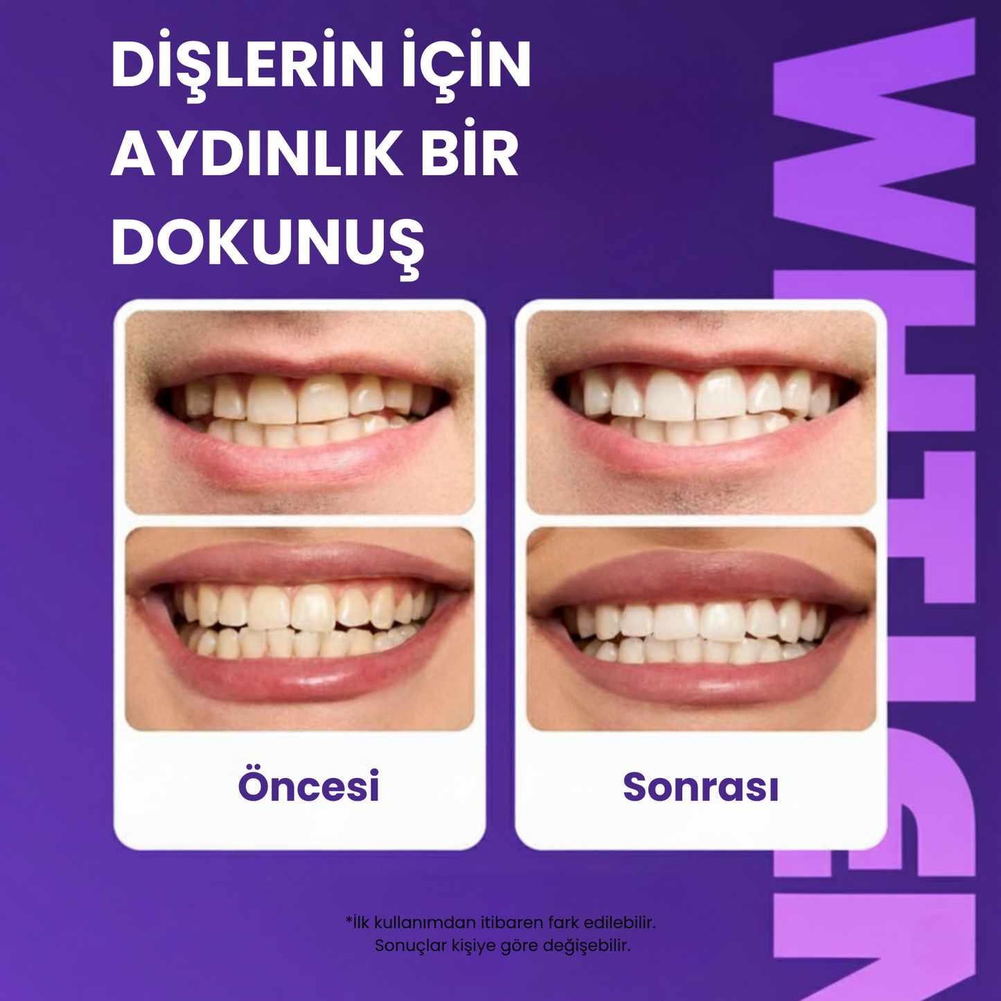 Diş Beyazlatma Bantları - Yeni Nesil Formül